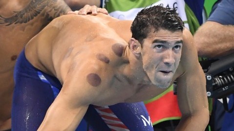 Cupping: have Olympians discovered the secret to success?